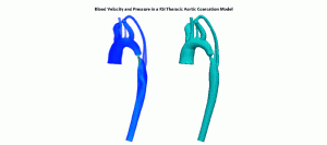 blood velocity and pressure in a FSI Thoracic Aortic Coarcation Model